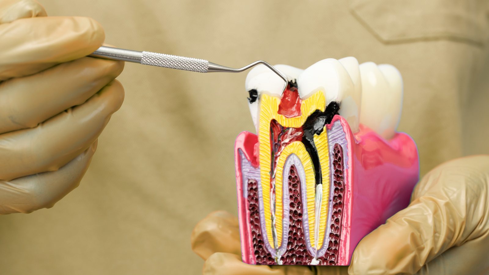 Root Canal Treatment at Ogilvie Dental in Gloucester